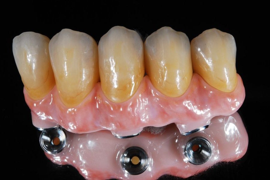 Kronen und Brücken in Zinkoxyd Zahnprothese mit mehreren Zähnen auf einer Basis und Metallankern.