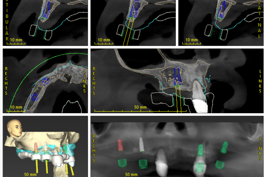 Implantatplanung Darstellung von Zahnimplantationen mit CT-Analysen und markierten Punkten zur Planung.