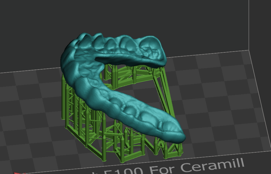 CAD-Modell einer Zahnprothese auf einem Bildschirm