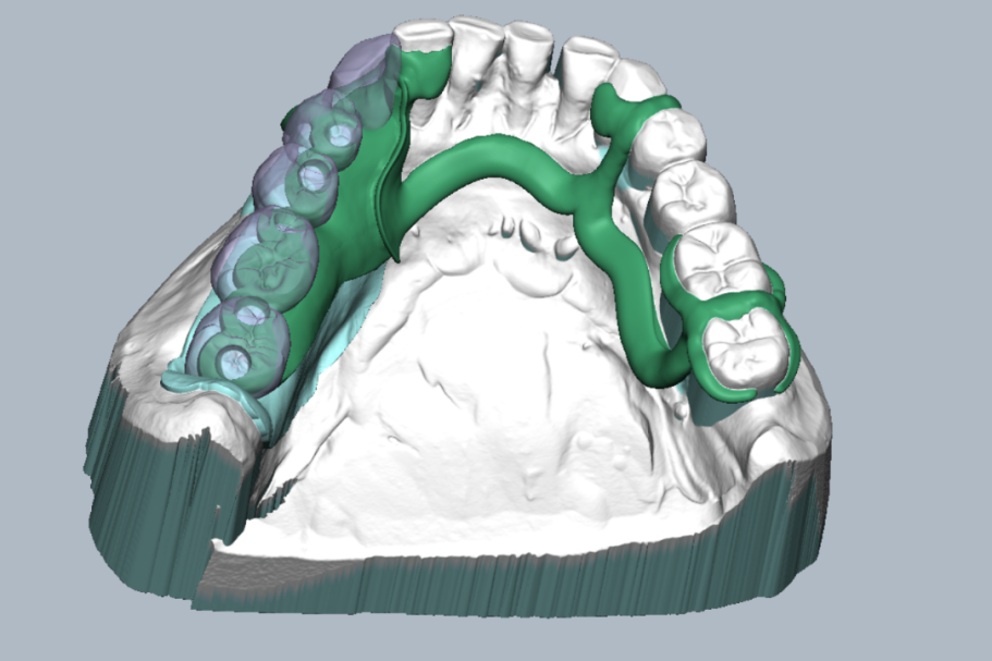 Digitaler Modellguß 3D-Modell eines Oberkiefers mit Zähnen und Zahnprothese in grün.