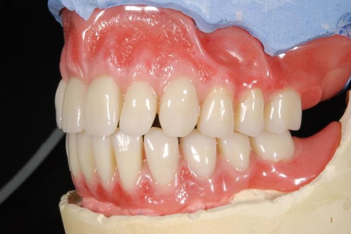 Total Prothetik Modell eines Gebisses mit weißen Zähnen und rotem Zahnfleisch.
