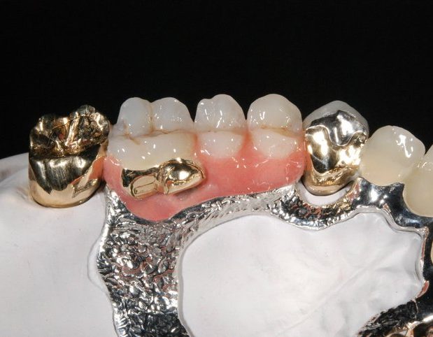 Titelbild der Seite Zahnprothesen mit goldenen Kronen und einer Zahnbasis aus rosa Material.