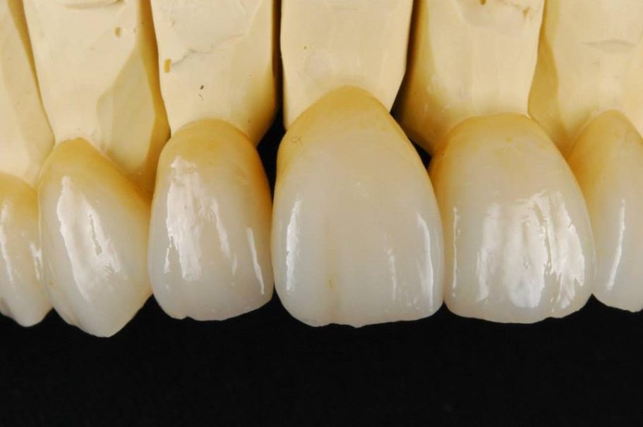 Individuelle Frontzahnästhetik Zahnprothesen in natürlicher Zahnfarbe, angeordnet in einer Reihe.