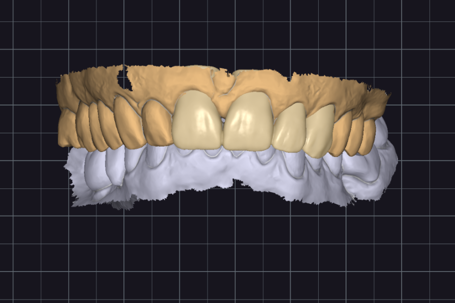 Digitales Mock Up und Schienenkorrektur 3D-Modell eines Gebisses mit hellen und weißen Zähnen auf dunklem Hintergrund.