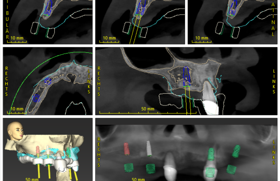 Röntgenaufnahmen des Kiefers mit Implantationsplan und anatomischen Markierungen.